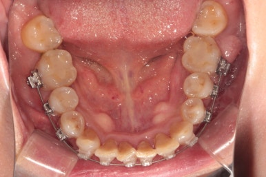 삐뚤어진 앞니를 8개월만에 가지런하게 만드는 50대 성인부분교정. 신사역 교정치과. 치료과정/기간/비용. 관련 이미지 14