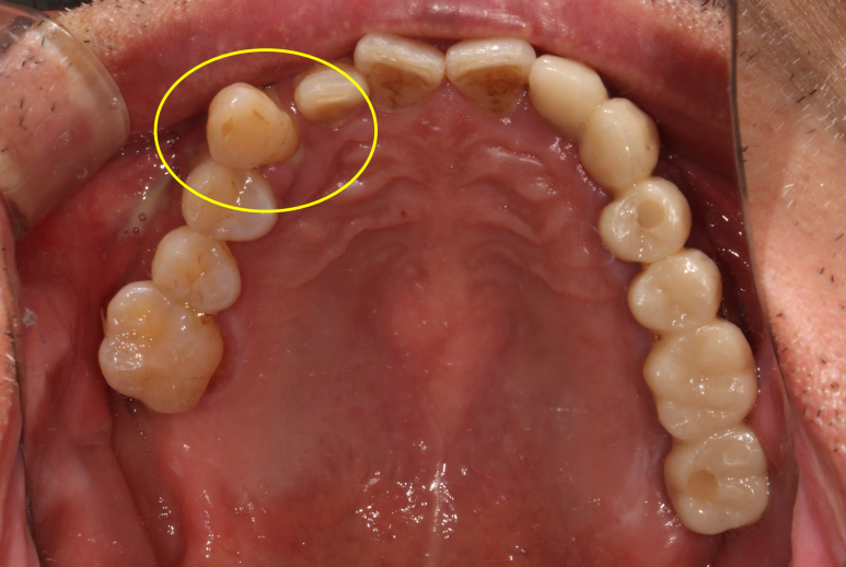 치주염 앞니 잇몸 염증으로 흔들릴 때 - 앞니 브릿지와 임플란트 장단점, 비용. 치료과정과 결과를 눈으로 보여주는 치과. 관련 이미지 8