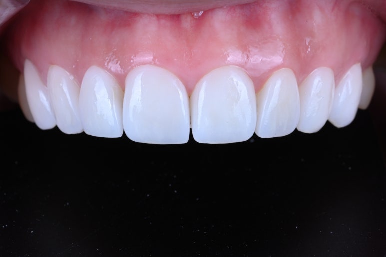 신사역 라미네이트. 결혼식 전 앞니 고민, 얇은 세라믹 레브네이트로 해결! 관련 이미지 16