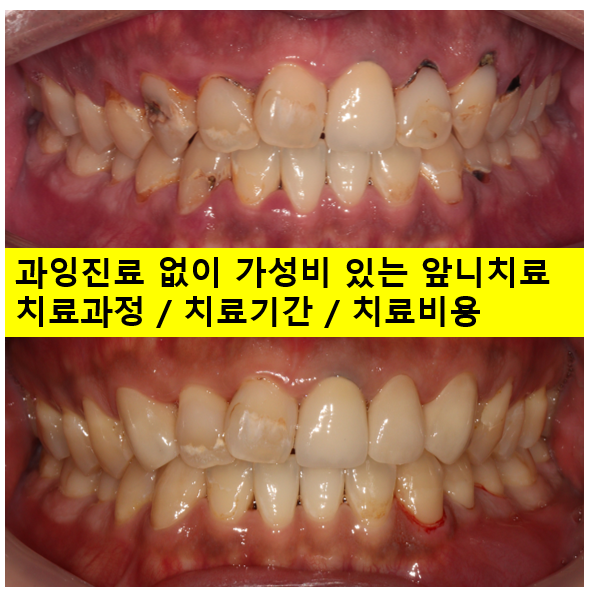 앞니 치료는 레진? 크라운? 치료계획은 이렇게 세운답니다. 과잉진료 안하고 치료하기. 치료과정/기간/비용. 관련 이미지 1
