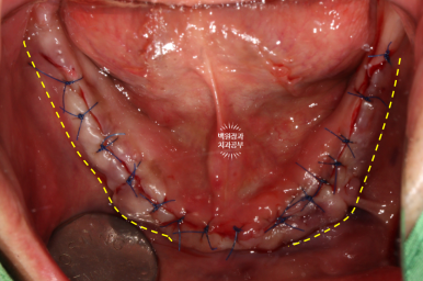 만성치주염으로 인해 아주 좁아진 잇몸뼈에 광범위한 뼈이식 + 전체임플란트. 신사 레브치과. 관련 이미지 38