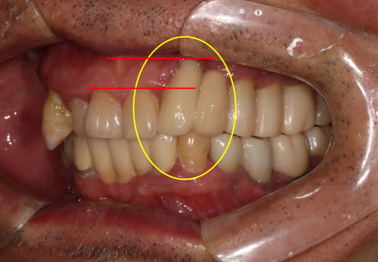 치주염 앞니 잇몸 염증으로 흔들릴 때 - 앞니 브릿지와 임플란트 장단점, 비용. 치료과정과 결과를 눈으로 보여주는 치과. 관련 이미지 6