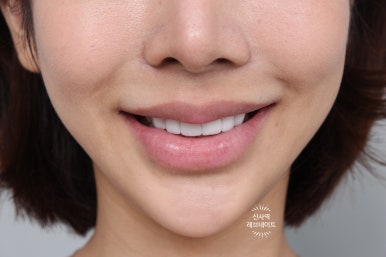 What About Laminates at Sinsa Station? Rev Dental Clinic’s Revnate. image 18