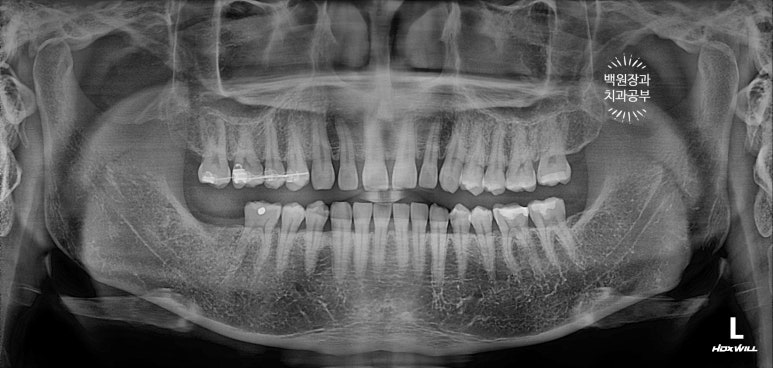 아래 어금니가 없어 위 어금니가 내려왔어요. 부분 교정을 곁들인 스트라우만 임플란트 수술. 억울한 신경치료를 피해보자. 치료과정/치료기간/비용/후기. 관련 이미지 6