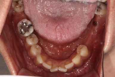전세계 1위 스트라우만 임플란트를 사용한 어금니 기능회복과 앞니 지르코니아 크라운 증례. 관련 이미지 7