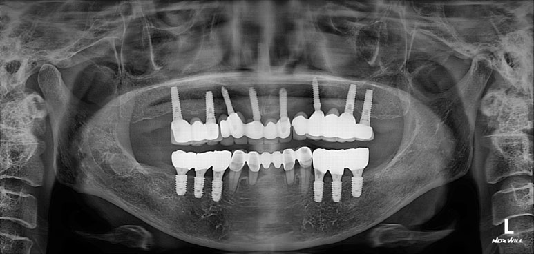 부분틀니를 오래써서 어금니가 아플 때, 아래턱 양쪽 어금니 임플란트 잘하는 강남임플란트치과 관련 이미지 27