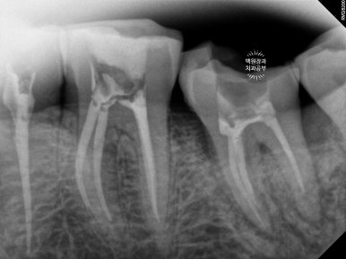 뿌리만 남은 앞니, 어금니가 없어 교합이 무너진 증례. 흡연자의 전체 오스템BA임플란트 재건증례. 치료과정/치료기간/비용/후기. 관련 이미지 10
