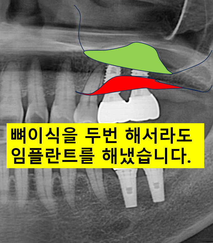 어금니 이빨 흔들림 잇몸이 부었을 때, 치주염에 걸린 치아를 뽑고 뼈이식을 해야할까요? 관련 이미지 1