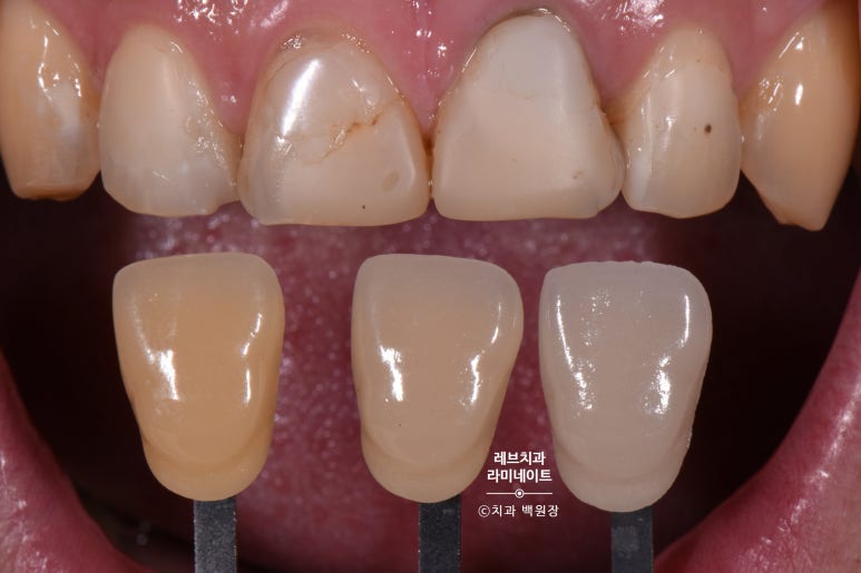 레브네이트 엑스퍼트 ; 유튜버가 선택한 앞니 라미네이트. 앞니 레진 벌어짐을 자연스러우면서 화사하게 바꿔봅시다. 신사역 치과. 치료후기/비용/가격. 관련 이미지 6