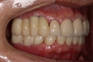 어금니 여러개가 없어요. 전체 임플란트와 앞니 크라운을 통한 완벽한 재건!! 치료과정/치료기간/비용/후기. 관련 이미지 28