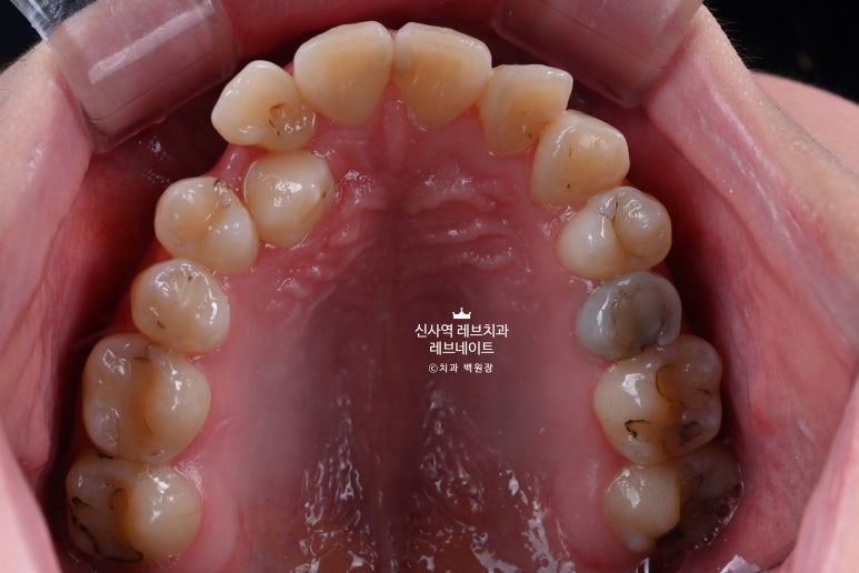 신사역 치과. 아나운서 면접 전 앞니 벌어진 공간을 라미네이트로만 해결할 수 있었던 사연.. 관련 이미지 5