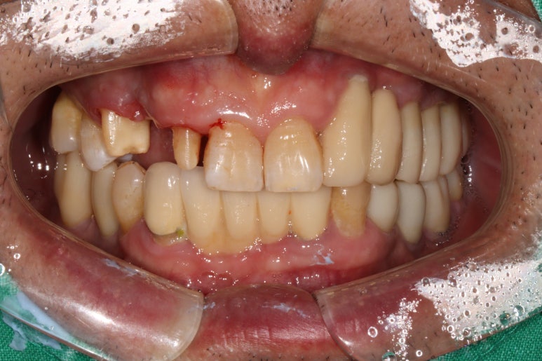 치주염 앞니 잇몸 염증으로 흔들릴 때 - 앞니 브릿지와 임플란트 장단점, 비용. 치료과정과 결과를 눈으로 보여주는 치과. 관련 이미지 10