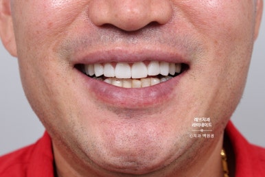 신사역 무삭제 라미네이트 : 레브네이트 내츄럴 최소삭제 비니어. 50대 앞니 벌어짐 비용/후기/얼굴사진. 관련 이미지 13