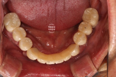만성치주염으로 인해 아주 좁아진 잇몸뼈에 광범위한 뼈이식 + 전체임플란트. 신사 레브치과. 관련 이미지 57