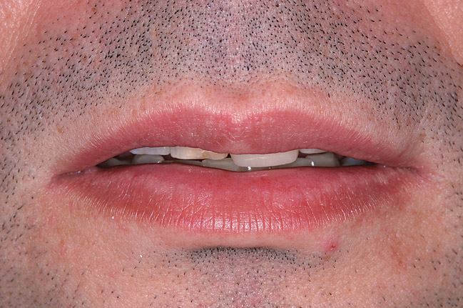 신사역 치과 - 이갈이와 이악물기의 치료. 좋은 보톡스와 이갈이 스플린트. 코어톡스 가격/주기/효과. 관련 이미지 3