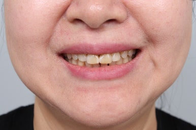 레브네이트 엑스퍼트 - 앞니 무삭제 라미네이트. 40대 벌어진 앞니에 변색된 레진은 이제 그만! 압구정 치과 추천 전후/비용. 관련 이미지 19