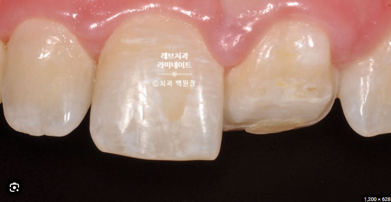 레브네이트 마스터 ; 예비신랑 앞니 무삭제라미네이트. 신사역 치과. 치료후기/비용/가격. 관련 이미지 9