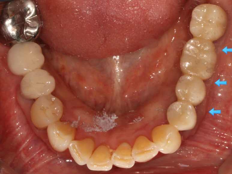어금니 임플란트 주변 잇몸이식수술 - 저는 해야한다고 생각합니다. (feat. 대한치과의사협회 논문 + 치주과전문) 관련 이미지 25