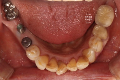 스트라우만 임플란트로 이뽑고 바로심는치과 - 믿고 사용하는 세계 1위 스위스 임플란트 회사. 관련 이미지 12