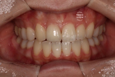 잇몸 성형과 치아미백 그리고 지르코니아 20대 앞니 크라운 치료. 치료과정/기간/비용. 관련 이미지 17