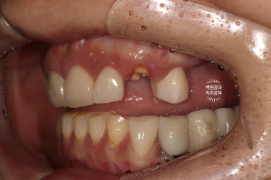 부분틀니 대신 어금니 임플란트를 만들어드립니다. 40대 어금니 상악동 뼈이식 임플란트. 치료기간/비용/과정. 관련 이미지 3