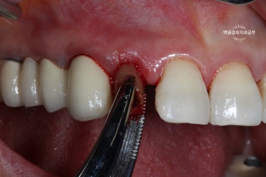 외과적 정출술 (surgical extrusion) - 치아를 살리는 마지막 방법. 치료과정/치료기간/비용/사진. 관련 이미지 5