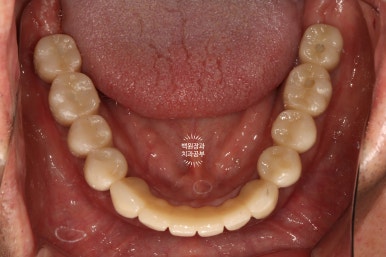 임플란트장인의 마음으로 8개월간 전체임플란트 완성. 치주과 전문의. 관련 이미지 32