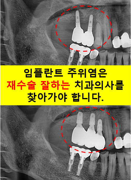 임플란트 주위염이 심하면? 임플란트 재수술을 잘하는 치과에 방문해보세요. 관련 이미지 2