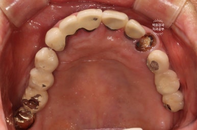 스트라우만 임플란트로 이뽑고 바로심는치과 - 믿고 사용하는 세계 1위 스위스 임플란트 회사. 관련 이미지 7