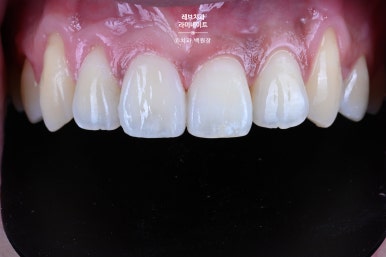 레브네이트 마스터 ; 예비신랑 앞니 무삭제라미네이트. 신사역 치과. 치료후기/비용/가격. 관련 이미지 16