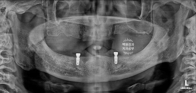 임플란트틀니 - 오버덴쳐. 오스템BA임플란트 이용한 최고의 가성비 치료. 치료과정/치료기간/비용/후기. 관련 이미지 10