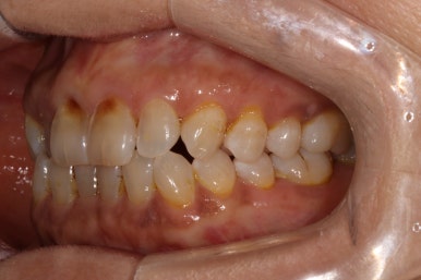 치아크랙 (금간 치아)의 찌릿한 통증 - 발치하지 않고 살려보기. 원인/진단/치료과정/비용/기간. 보존과전문의 치과. 관련 이미지 5