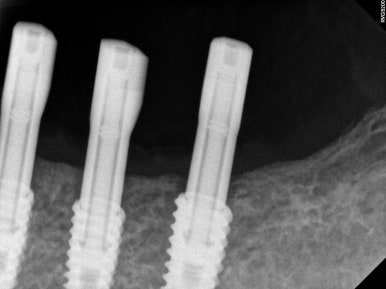 부분틀니를 오래써서 어금니가 아플 때, 아래턱 양쪽 어금니 임플란트 잘하는 강남임플란트치과 관련 이미지 16