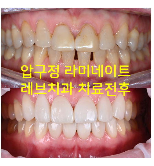 레브네이트 엑스퍼트 - 앞니 무삭제 라미네이트. 40대 벌어진 앞니에 변색된 레진은 이제 그만! 압구정 치과 추천 전후/비용. 관련 이미지 1