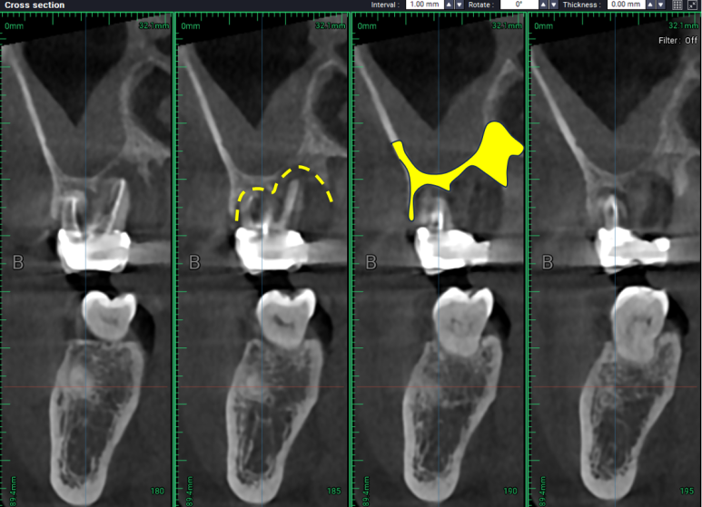 치아와 임플란트를 연결하면 치아가 망가집니다. 발치 동시 치조골 이식 후 임플란트. 치료과정/치료기간/비용/후기. 관련 이미지 10
