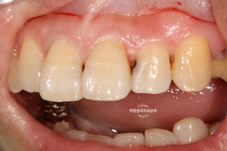 앞니레진치료 할 줄 모르는 치과의사는 없지만, 좋은 레진으로 치료하는 치과의사는 잘 없습니다. 관련 이미지 21