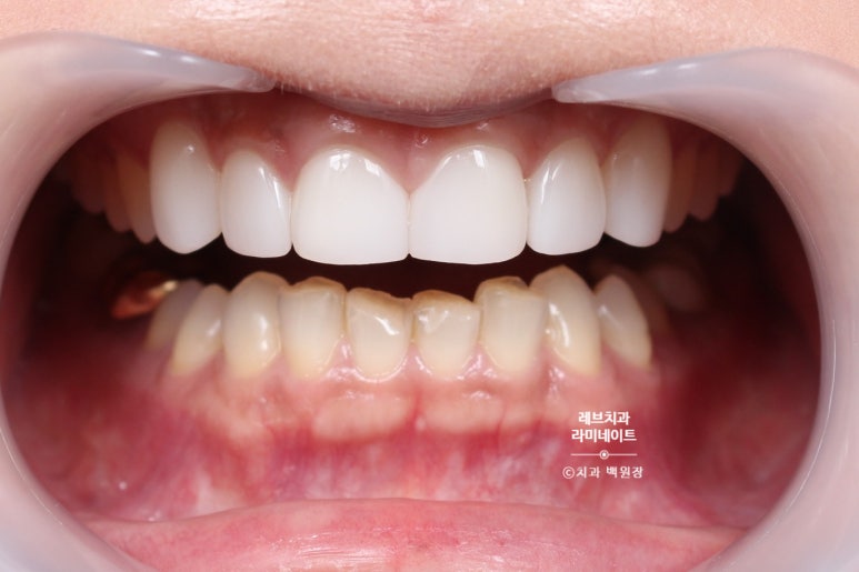 아래앞니 라미네이트도 무삭제로 가능한가요? 레브네이트 베이직 가격/비용/후기/추천. 관련 이미지 7