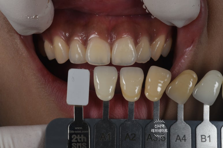 What About Laminates at Sinsa Station? Rev Dental Clinic’s Revnate. image 12