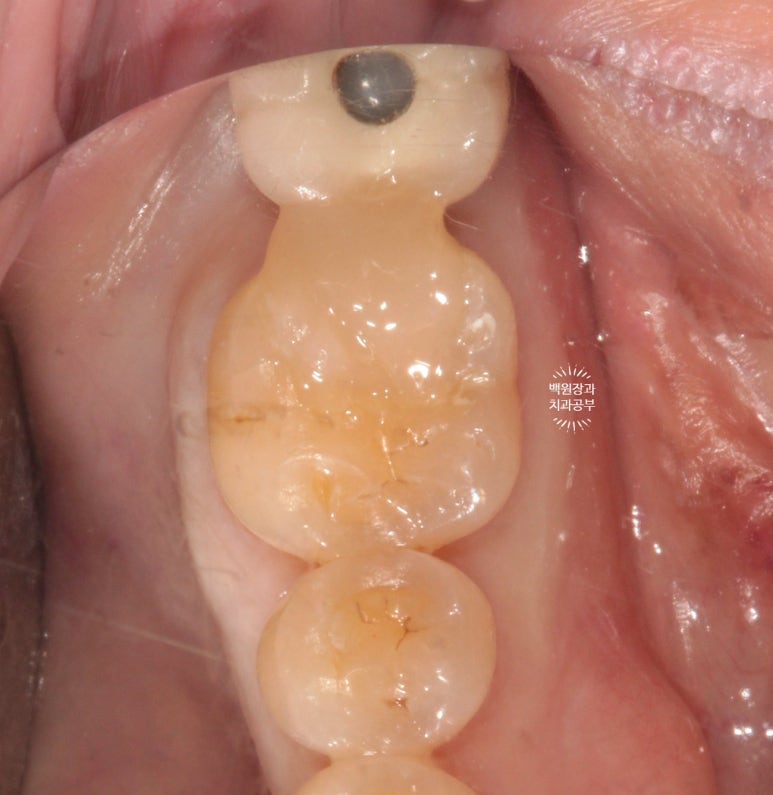 어금니 보철물이 떨어졌어요. 골드인레이 탈락 후 지르코니아 크라운으로 치료. 충치치료과정/치료기간/비용/후기. 관련 이미지 8