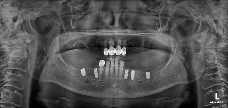 어금니 여러개가 없어요. 전체 임플란트와 앞니 크라운을 통한 완벽한 재건!! 치료과정/치료기간/비용/후기. 관련 이미지 9