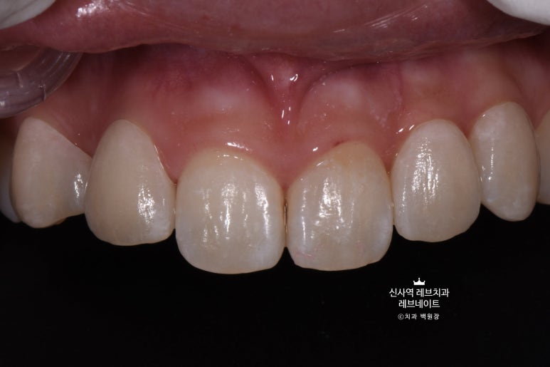 신사역 치과. 아나운서 면접 전 앞니 벌어진 공간을 라미네이트로만 해결할 수 있었던 사연.. 관련 이미지 18