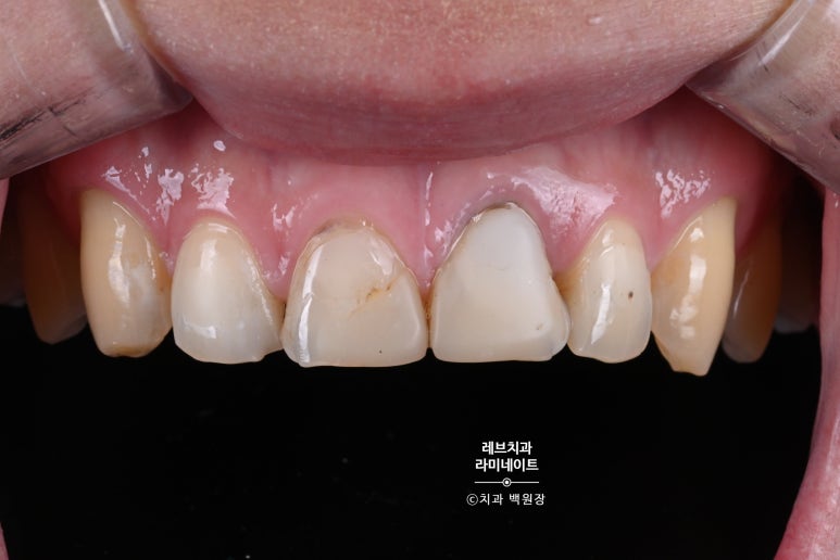 레브네이트 엑스퍼트 ; 유튜버가 선택한 앞니 라미네이트. 앞니 레진 벌어짐을 자연스러우면서 화사하게 바꿔봅시다. 신사역 치과. 치료후기/비용/가격. 관련 이미지 5