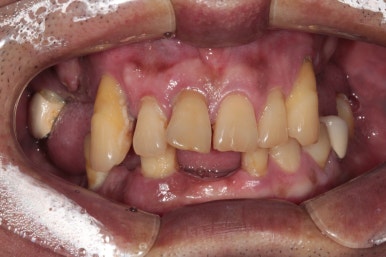 큰 어금니를 잃을 정도의 풍치를 앓으셨다면, 조속한 어금니 임플란트는 필수입니다. 관련 이미지 14