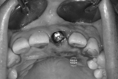 앞니 머리가 기둥째 부러졌어요. 발치 동시 뼈이식 오스템 BA 임플란트. 치료과정/치료기간/비용/후기. 압구정 치과. 관련 이미지 8