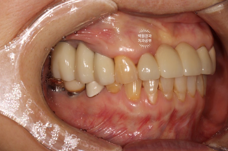 60대 임플란트 주변에서 고름이 나와요. 실패한 임플란트 제거 후 재수술. 덴티움 뼈이식재를 사용한 치조골 이식술. 관련 이미지 19