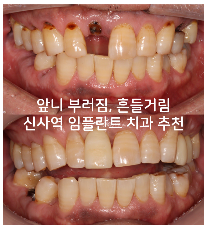 앞니 부러짐? 뽑고 바로 임플란트 + 뼈이식. 앞니 흔들림? 뽑고 1달 기다리고 임플란트 + 뼈이식. 신사역 치과 후기/비용/과정. 관련 이미지 1