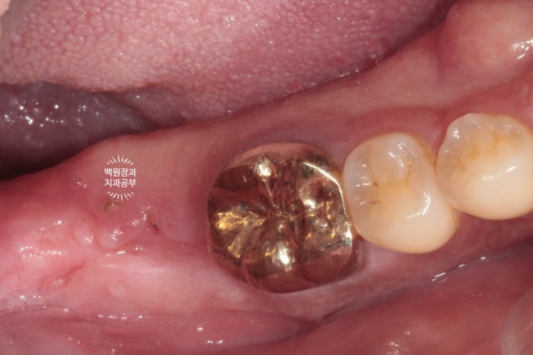 신경치료한 치아 부러짐! 뼈이식 하면서 임플란트 수술하는 과정/기간/비용. 관련 이미지 11