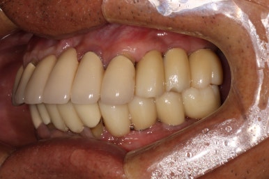 잇몸 염증 고름이 심했던 부위 - 만성치주염 진단하고 임플란트로 깔끔하게 치료! 신사역 치과 관련 이미지 31