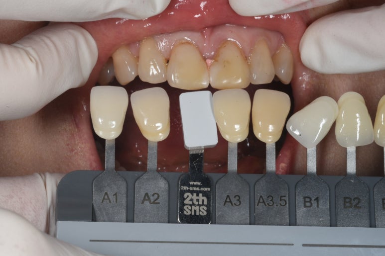 레브네이트 엑스퍼트 - 앞니 무삭제 라미네이트. 40대 벌어진 앞니에 변색된 레진은 이제 그만! 압구정 치과 추천 전후/비용. 관련 이미지 9