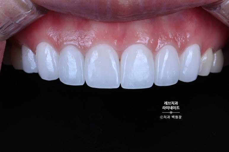 신사역 퍼스널컬러 맞춤 치과. 전담 세라미스트가 앞니 크라운과 라미네이트를 만들어 드립니다. 관련 이미지 15